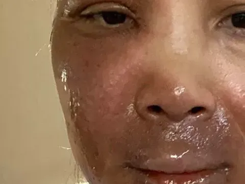 Ca sĩ Hồng Ngọc công khai khuôn mặt bỏng nước sôi ai thấy cũng xót xa